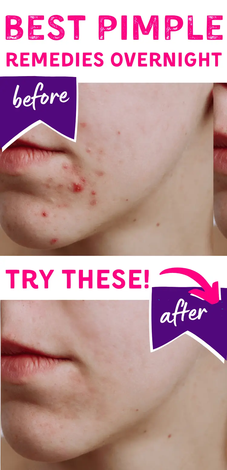 how-to-remove-pimples-fast-naturally-and-permanently-vel-illum