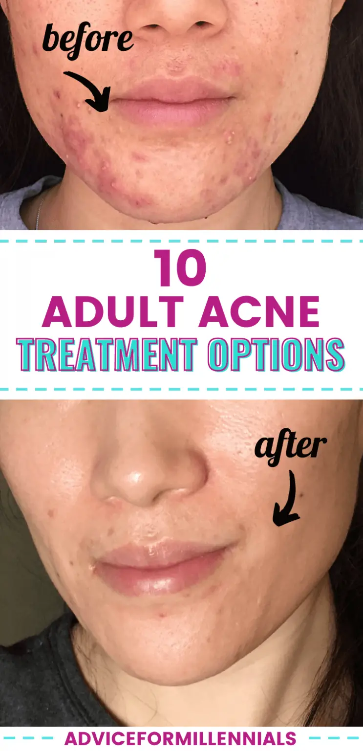 10 Adult Acne Treatment Options You (Probably) Haven't Tried Yet