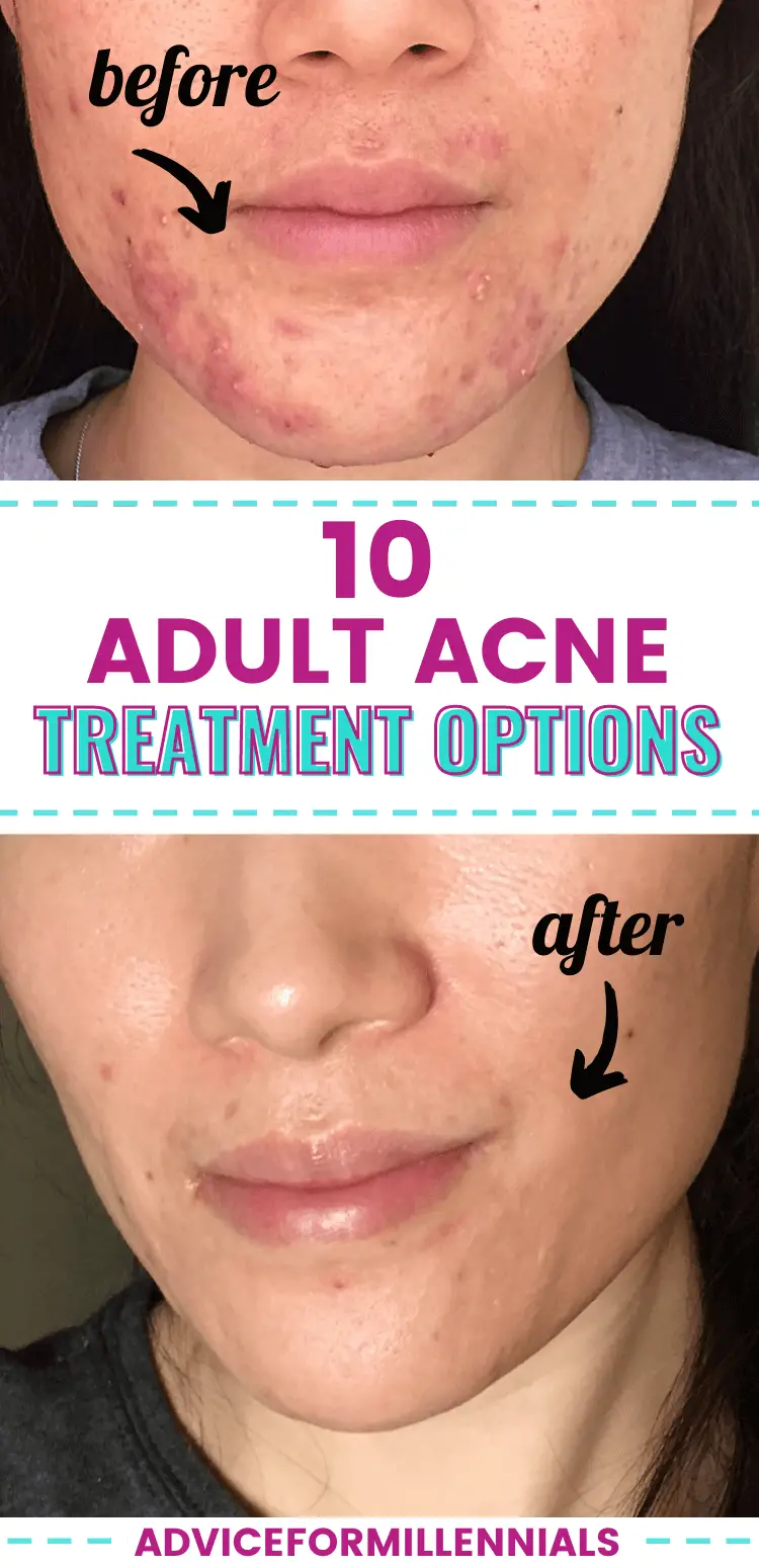 10 Adult Acne Treatment Options You Probably Havent Tried Yet Advice For Millennials 9063